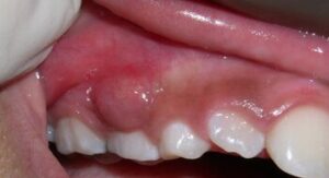 Dental abscess or tooth abscess